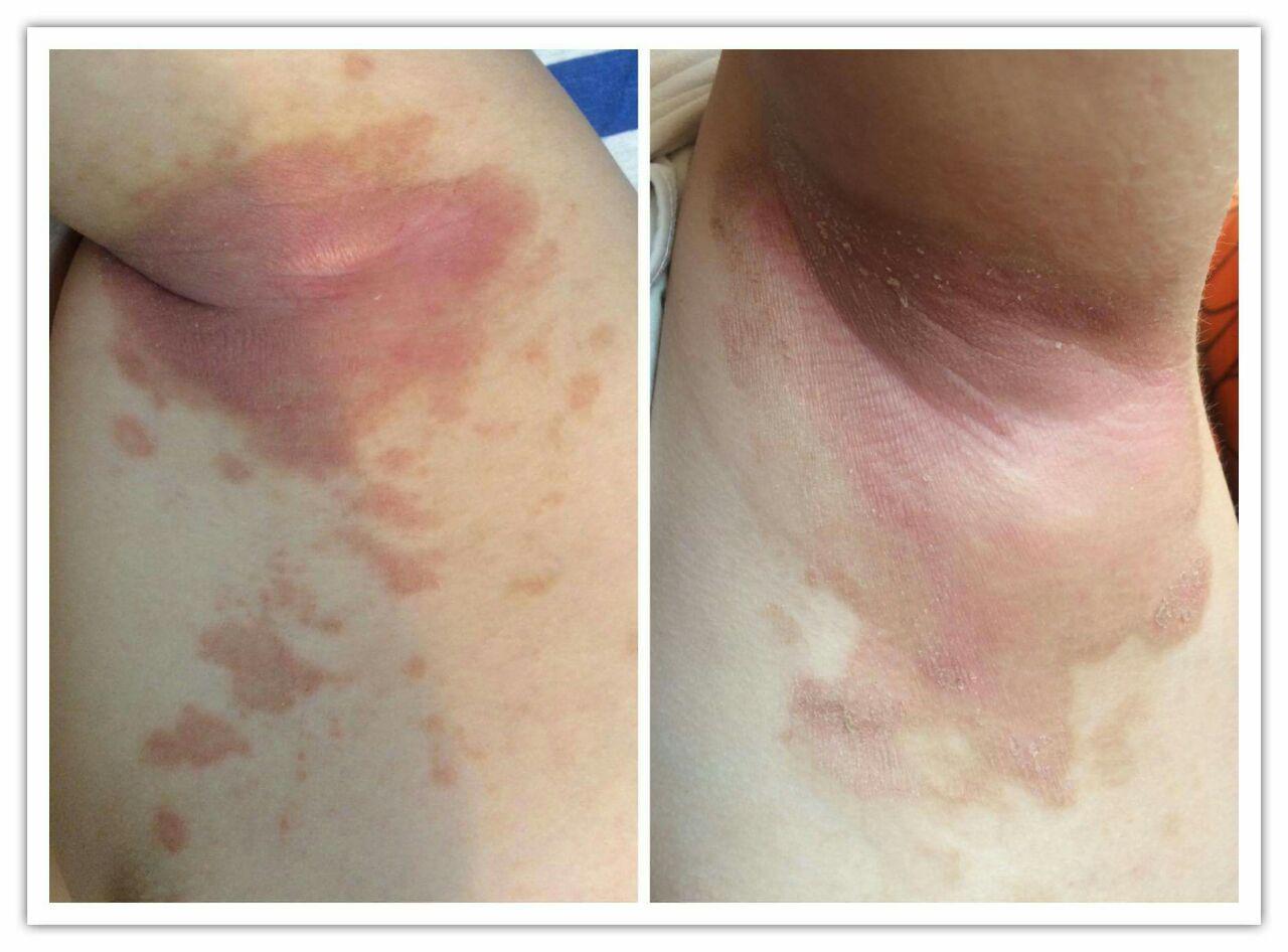 Противогрибковая программа от Aurora в раснодаре Противогрибковая программа от Aurora в раснодаре