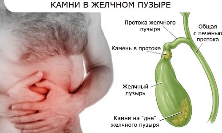 Камни в желчном что делать