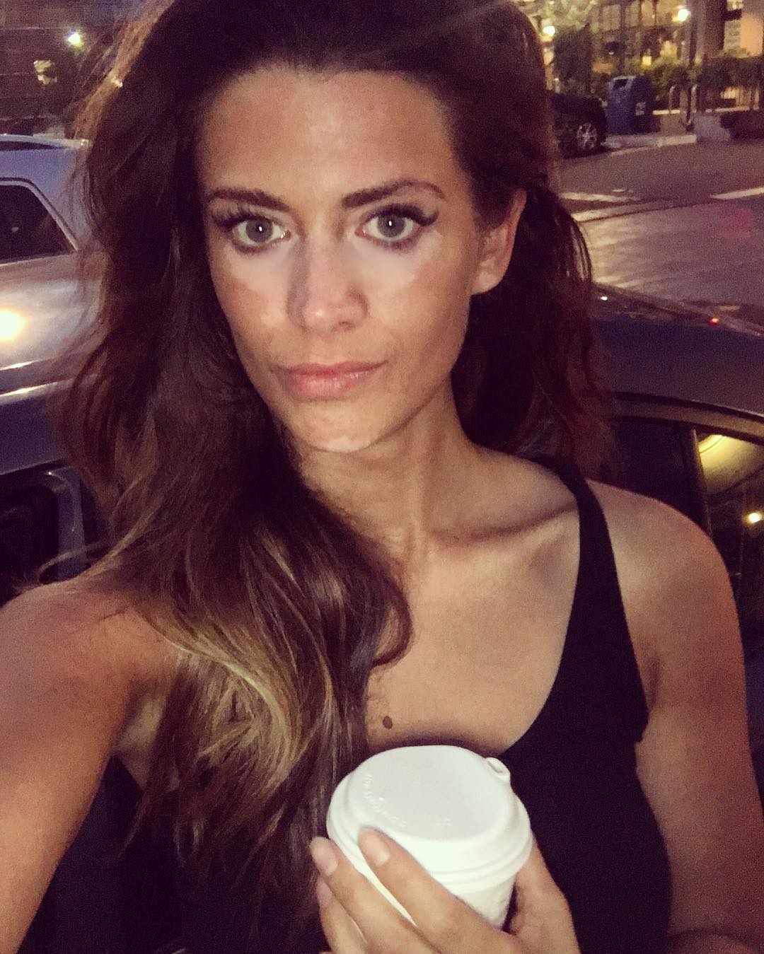 Заболевание Витилиго