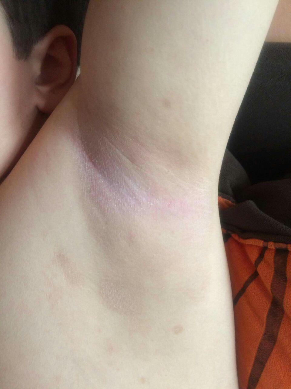 Противогрибковая программа от Aurora в раснодаре Противогрибковая программа от Aurora в раснодаре