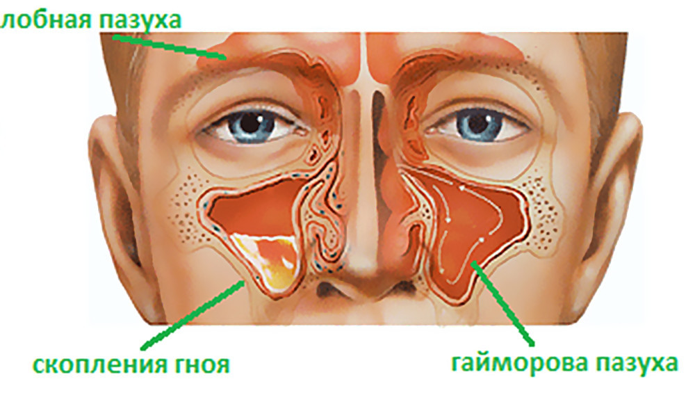 Острый гнойный гайморит - лечение Острый гнойный гайморит - лечение