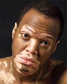 Заболевание Витилиго