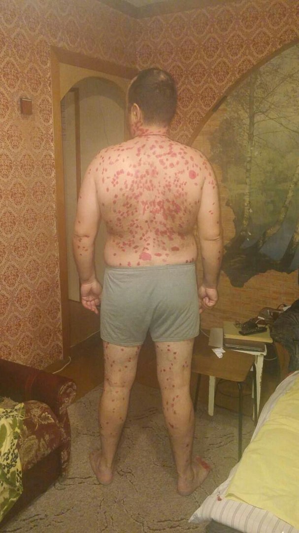 Противогрибковая программа от Aurora в раснодаре Противогрибковая программа от Aurora в раснодаре